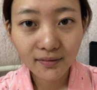 我被夸赞疯了，姐妹们都吵着要做我的同款注射太阳穴填充呢