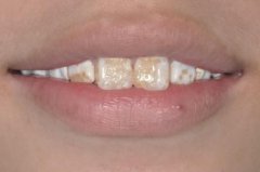 感谢成都博爱现在的我爱死了如今的白牙，终于可算能开口大笑了