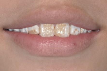 感谢成都博爱现在的我爱死了如今的白牙,终于可算能开口大笑了