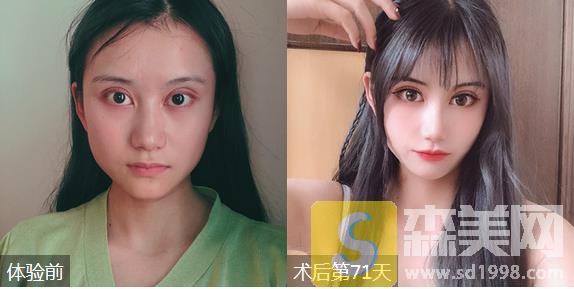 深圳福华医院整形价格表2021，隆鼻果真的绝绝子！