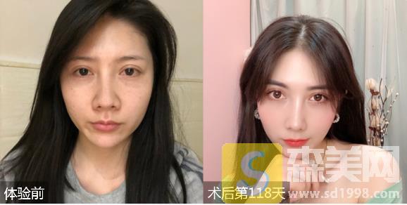 深圳福华医院整形价格表2021，隆鼻果真的绝绝子！