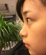 济南赵广生的鼻部手术恢复日记,真的不摆了,太赞了