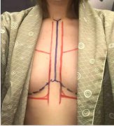 唐山美仁美容医院整的假体隆胸，漂亮的我都看这害羞了