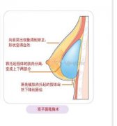 双平面隆胸的果真是让我太惊讶了