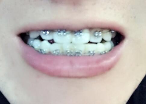 在成都华西口腔医院做的牙齿矫正果超赞,让三十岁的我中午敢笑了