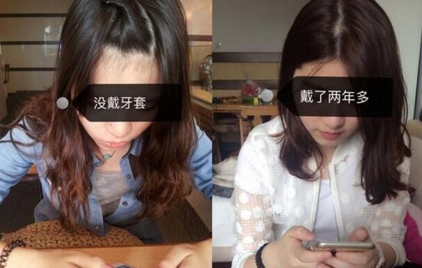 在大连口腔医院做的矫正已经有两年的时间了