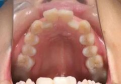 牙齿的问题让我自卑，幸亏在小白兔口腔医院做了矫正