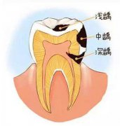 从小不注重口腔卫生,这龋齿可把我害惨了