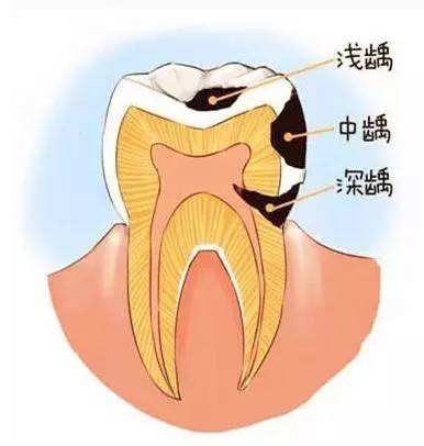 从小不注重口腔卫生,这龋齿可把我害惨了