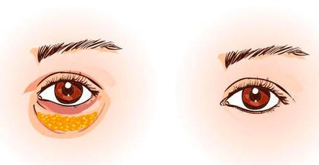 割掉这又老又黑的黑眼袋,马上我看起来就精神百倍