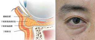 割掉这又老又黑的黑眼袋,马上我看起来就精神百倍
