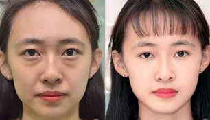 割掉这又老又黑的黑眼袋,马上我看起来就精神百倍