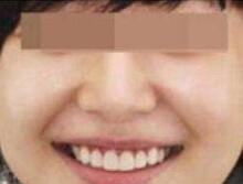 整形医生李晓楠的技术水平-案例展示-项目价格-广州曙光口腔医院