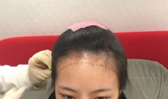 武汉新生植发拯救了我的发际线,再也不是秃头girl了