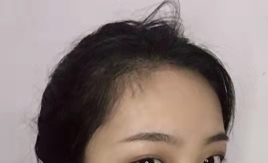 武汉新生植发拯救了我的发际线,再也不是秃头girl了