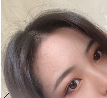 武汉新生植发拯救了我的发际线,再也不是秃头girl了