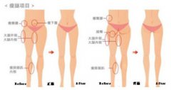 河南做的大腿吸脂治疗 本集美已把短裙安排上了