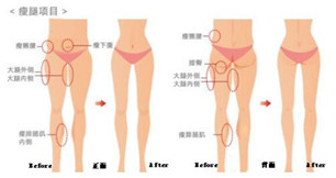 河南做的大腿吸脂治疗 本集美已把短裙安排上了
