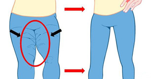 河南做的大腿吸脂治疗 本集美已把短裙安排上了