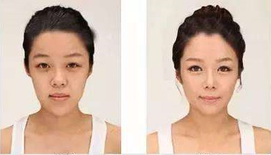 男友看了半天都不觉得我在济南星范做的假体鼻 哪里有瑕疵