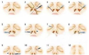 来给集美帮我看看 我在厦门安黛医院做的隆鼻是不是超赞