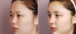 来给集美帮我看看 我在厦门安黛医院做的隆鼻是不是超赞