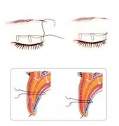 哎呦!这可不得了，在宁波薇琳do的双眼皮可太惹人爱了