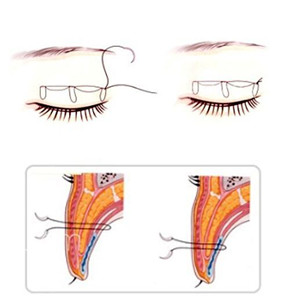 哎呦!这可不得了，在宁波薇琳do的双眼皮可太惹人爱了