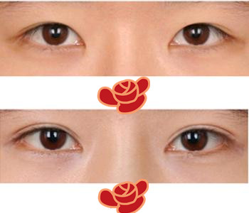 哎呦!这可不得了，在宁波薇琳do的双眼皮可太惹人爱了