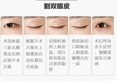 这在沈阳伊尔美做的双眼皮，少有地点不好的就是太自然了