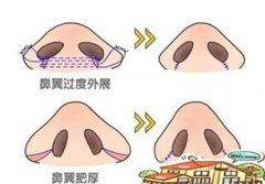 王大山大夫在武汉欧尚美帮我做的缩鼻翼，术后36天见真章