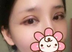 在武汉中澳完成了我梦寐以求的双眼皮