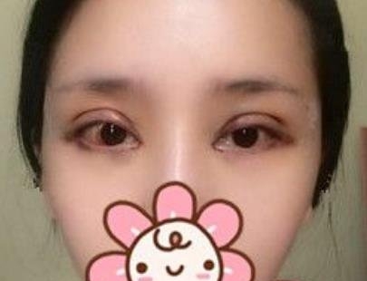 在武汉中澳完成了我梦寐以求的双眼皮