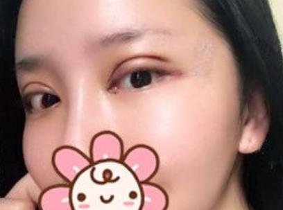 在武汉中澳完成了我梦寐以求的双眼皮