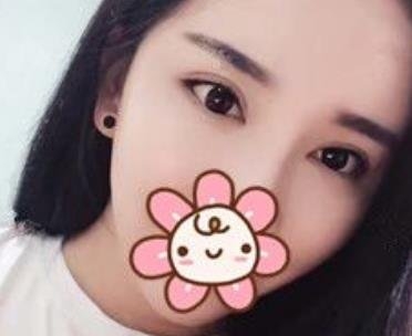 在武汉中澳完成了我梦寐以求的双眼皮