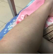 激光脱毛终于让我有自信可以露出大长腿了，感谢上海华美