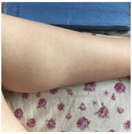 激光脱毛终于让我有自信可以露出大长腿了，感谢上海华美