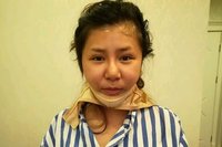 在初美医疗美容医院进行了面部吸脂，终于让我摆脱掉了大脸猫