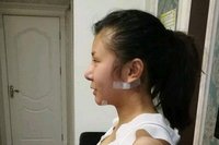 在初美医疗美容医院进行了面部吸脂，终于让我摆脱掉了大脸猫