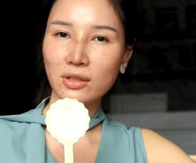 终于和红血丝说拜拜了,感谢山东省立医院