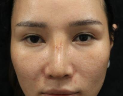 终于和红血丝说拜拜了,感谢山东省立医院