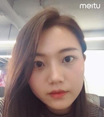 华美医院帮我去除了烦人的眼袋