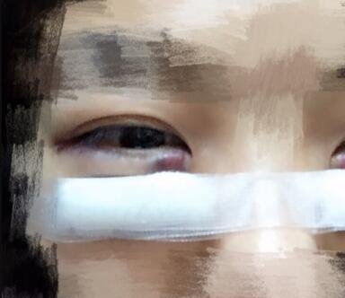 华美医院帮我去除了烦人的眼袋