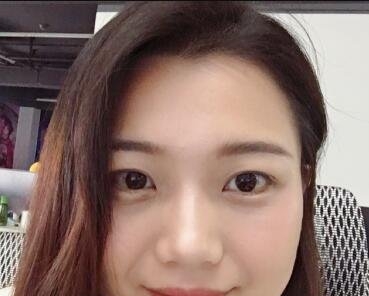 华美医院帮我去除了烦人的眼袋