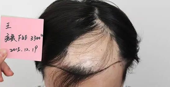 头上有疤痕能不能植发-广东雍禾植发