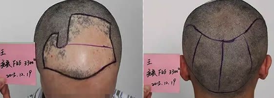 头上有疤痕能不能植发-广东雍禾植发