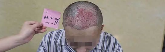 头上有疤痕能不能植发-广东雍禾植发