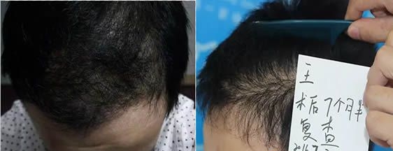头上有疤痕能不能植发-广东雍禾植发