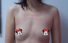 在沈阳美莱的做乳头缩小，让我没了尴尬