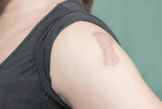 上海疤痕修复医院哪里比较好？术后果怎么样？